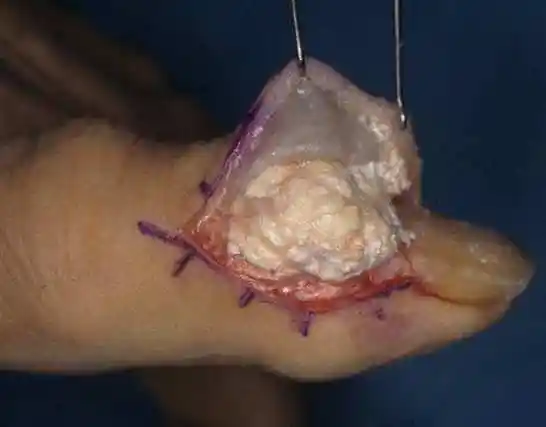 嘌呤摄入过多尿酸变高,容易形成尿酸结晶,3招简单降尿酸