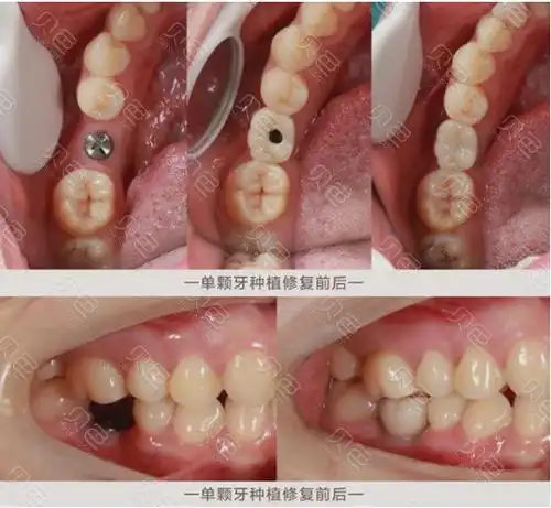 种植牙照片