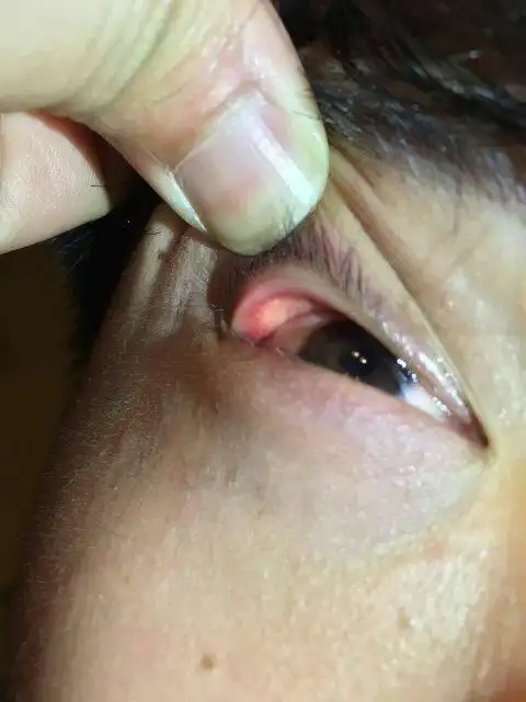 我眼睛里长了一大一小的两个白点,长在眼皮上的,这是什么,眼睛有点胀