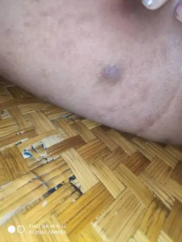 大腿根内测有个硬疙瘩