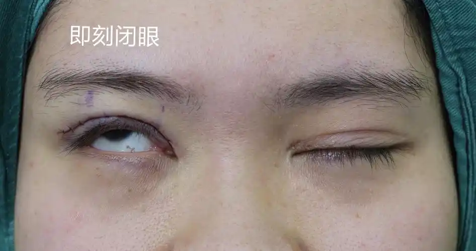 河北90后姑娘右眼上睑下垂做了一次效果不好,来找我们做了修复