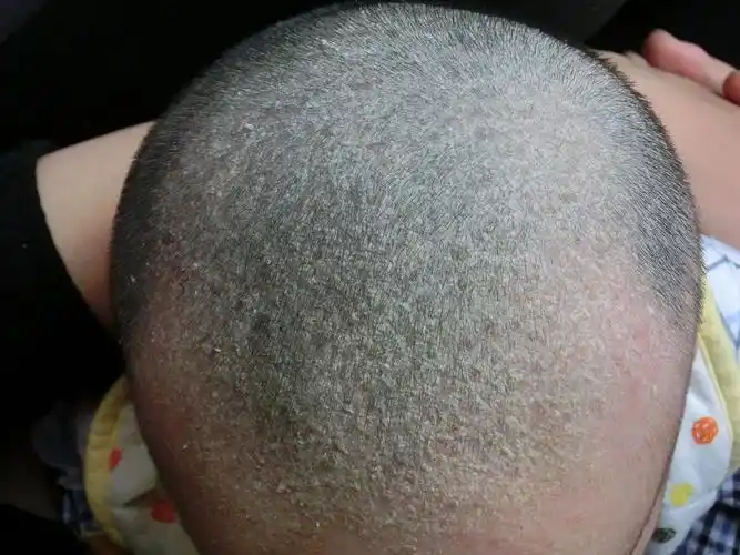 小宝宝长头皮屑应该是干癣,表现为头屑和头发的破坏,严重时可伴有炎症