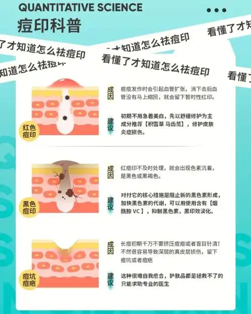 祛痘印攻略红黑痘印轻松淡化