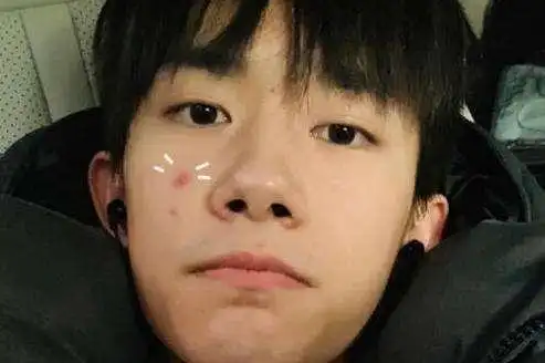 易烊千玺越长越帅对比图他素颜满脸痘痘真的假的