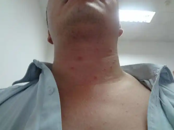 我十年前得过梅毒,自己服用多西环素1个