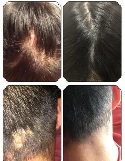 头痒去屑 头上长疙瘩改善头皮毛囊洗炎去疙瘩痘痘头皮洗发水露去屑