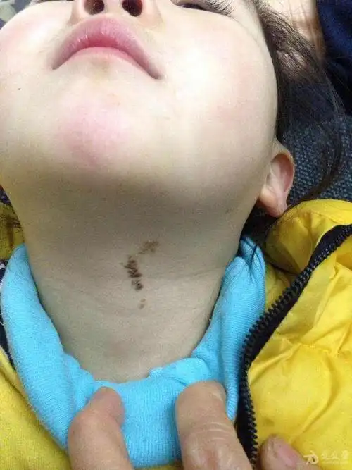 儿童颈部先天色素痣