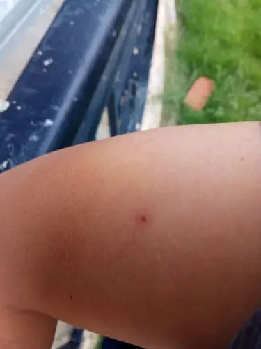 手臂上长个蜘蛛痣.这是蜘蛛痣吗?