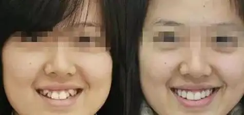 虎牙是指长在上颌门牙旁的两颗尖牙,又被称为犬齿,在所有牙齿中牙根是