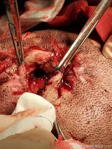 穿掘性毛囊炎手术中