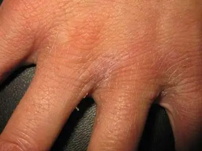 疥疮的早期症状有哪些