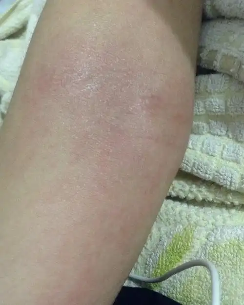 胳膊肘很痒.红红的一片,还扩散,这个怎么办什么病.已经持续三个月了.