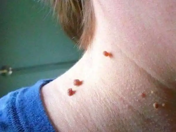 疣是什么样子图片(脖子上长的小肉粒是什么) - 赤虎壹号