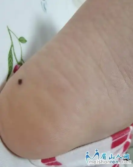 今天去医院看皮肤科,脚底长了一个痣,医生喊我去弄掉,说容易癌变!