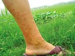 过敏性皮炎的典型症状_【合肥肤康皮肤病医院】_合肥治疗皮肤病专科