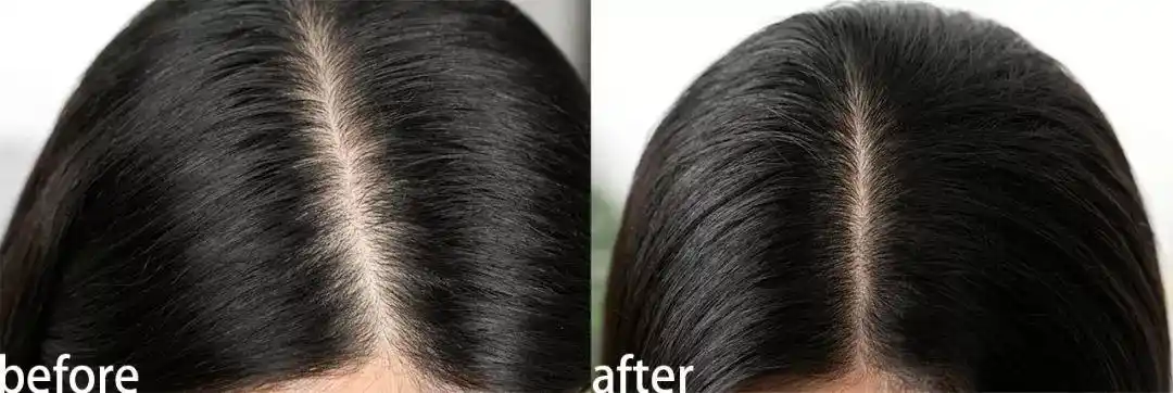 明星自用的生发神器,每天滴一滴,感觉头发要疯长_头皮