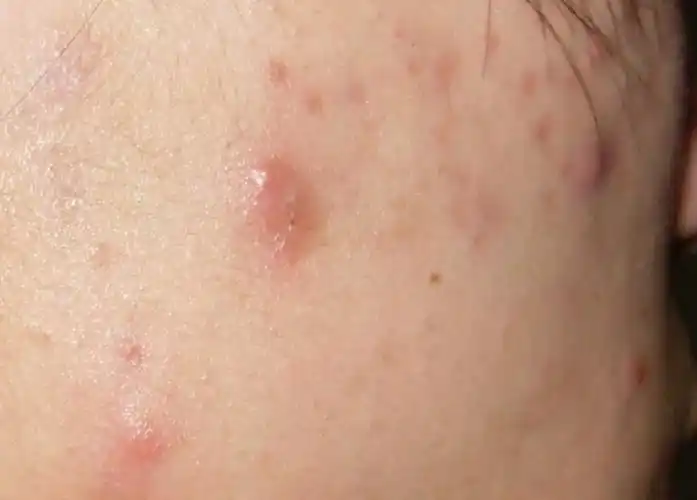 我脸上长的这是疖子还是脓包?还是什么疮啊 医生大人请进