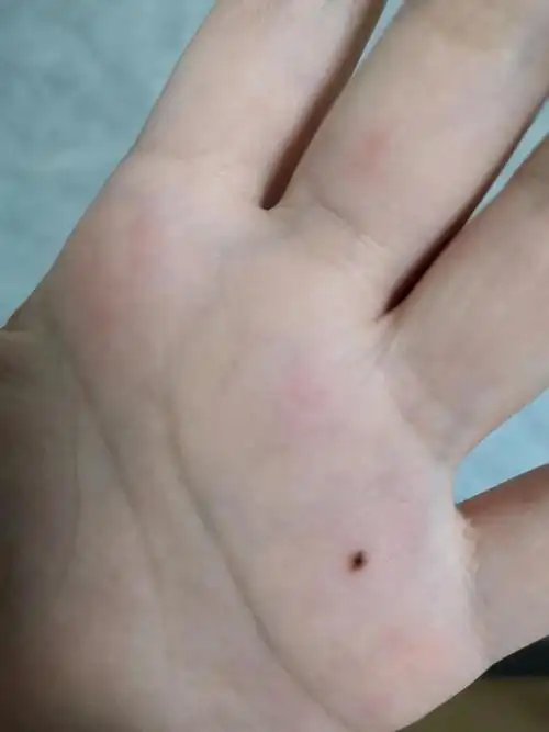 近一年手心突然长了两颗痣