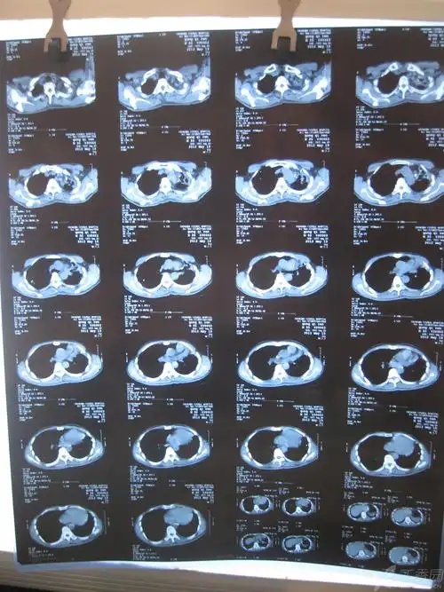 2012-5-15胸部ct平扫(a医院)