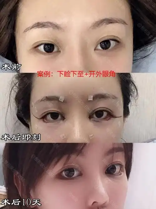 下睑下至这么火,医生为什么不给我做?