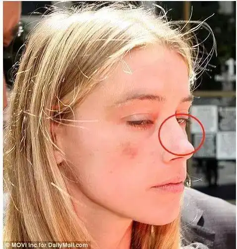 鼻梁起节鼻子露骨