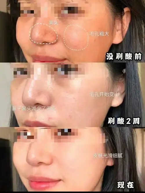 更赢在姿态93想给你独一无二的美丽95#果酸换肤  #我的护肤日常