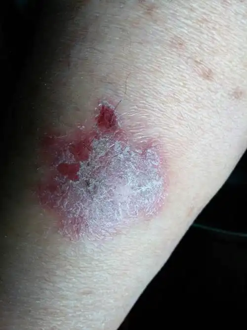 三年前小腿肚子上长了一块红斑,当时没有在意,现在已经很大了,听朋友