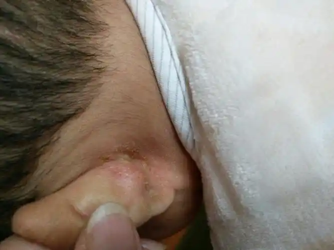 耳朵后面有黄色结痂