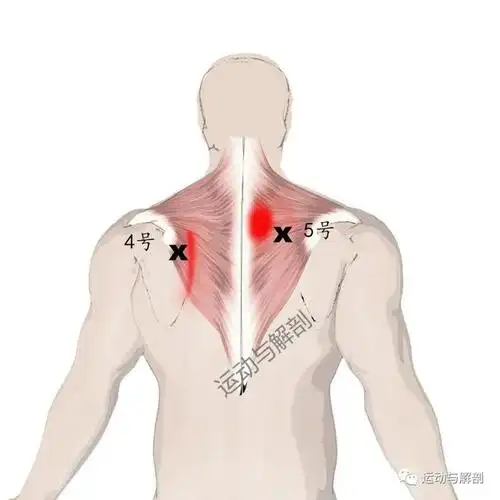 如何松解斜方肌触发点解决上背部头颈部疼痛问题