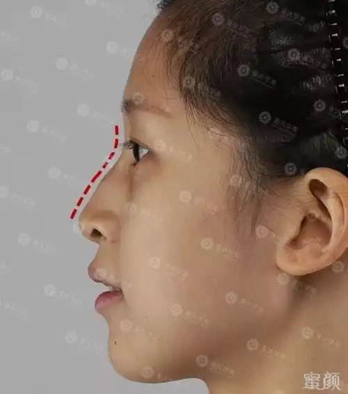 杨子兮术前侧面对于这种类型的驼峰鼻,张院会采用另一种手术方式.