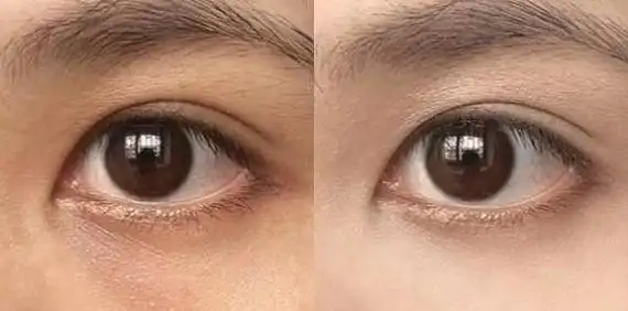 眼周出现小细纹,快用它.淡化细纹去浮肿,让你笑起来更迷人!