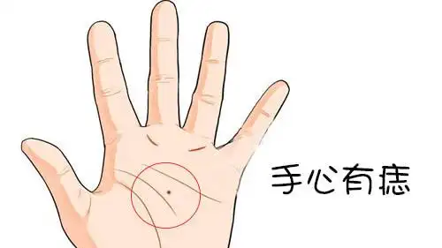手心痣代表什么,手心长痣是好是坏?