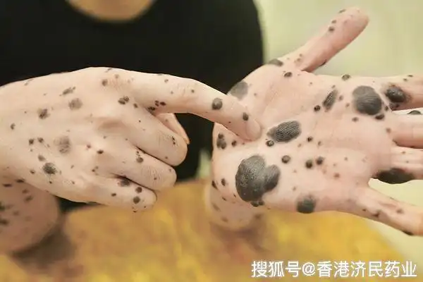 黑色素瘤的三大早期症状