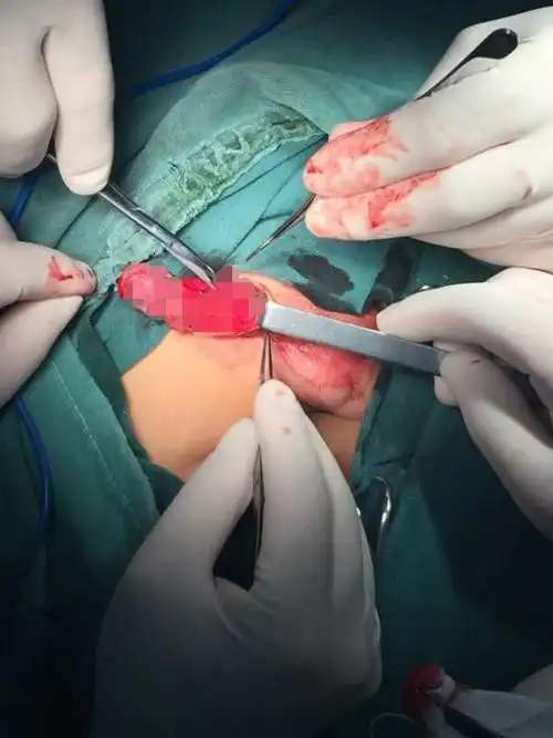 包皮上翻,阴茎延长!