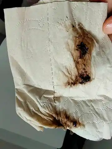 怀孕49天出现褐色排泄物是什么情况