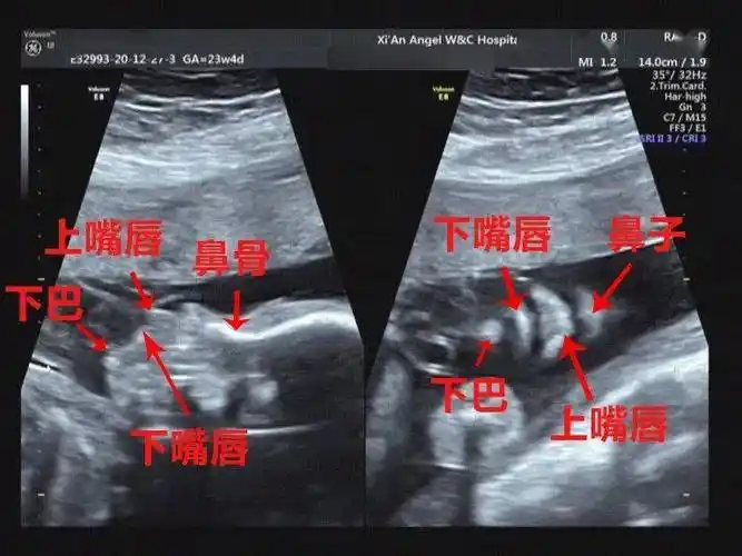 胎儿_颜面_照片