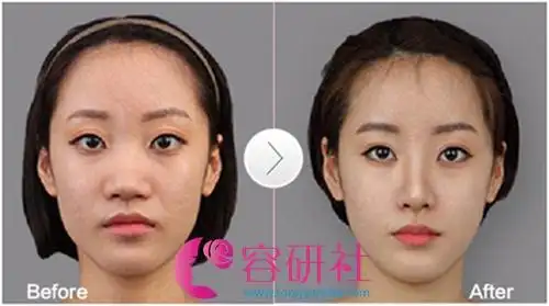 玻尿酸隆鼻前后效果对比