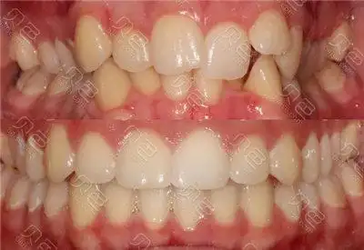 牙齿矫正前后对比