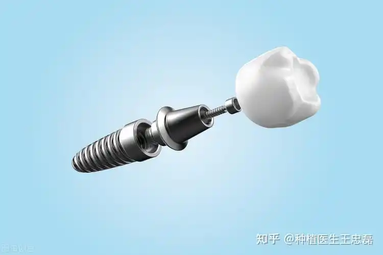 种植牙的"螺丝纹"设计有什么作用?专家告诉你答案