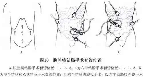 (一)治疗结肠癌的治疗仍以外科手术为根治的基础,有