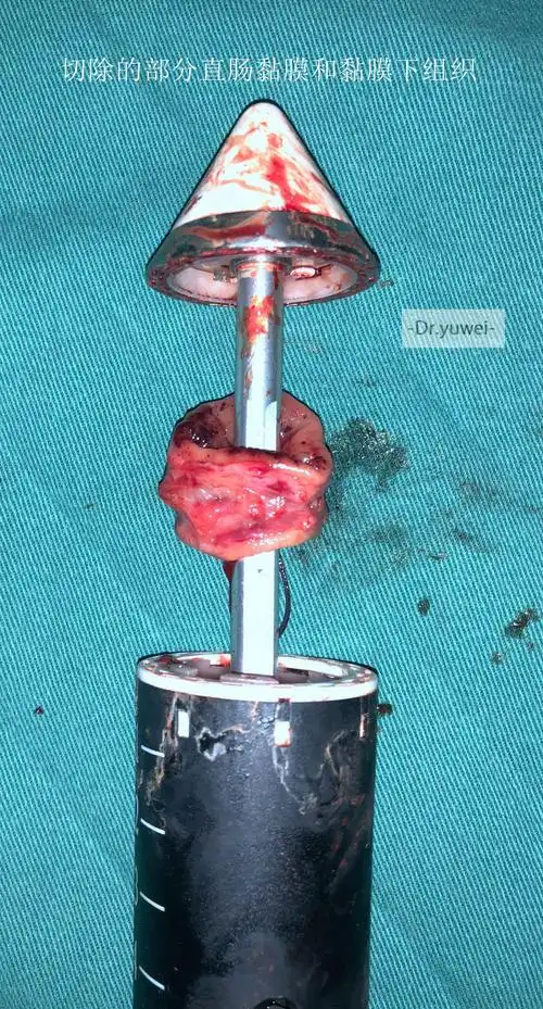 治疗痔疮的pph手术简介_痔疮_治疗方式_治疗介绍 - 好大夫在线