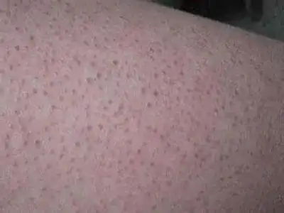 常见的背部肌肤问题▲鸡皮肤▲我们常说的"鸡皮肤",学名叫毛周角化症