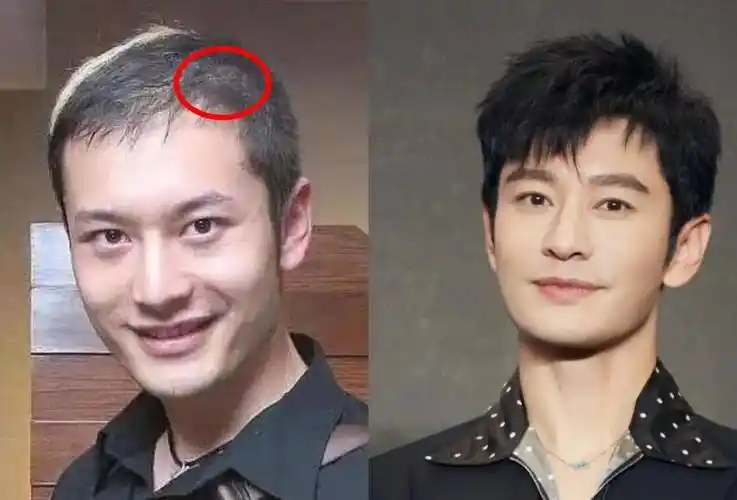 黄晓明有着一头乌黑亮丽的头发,但看他以前的照片,发量稀疏,发际线更