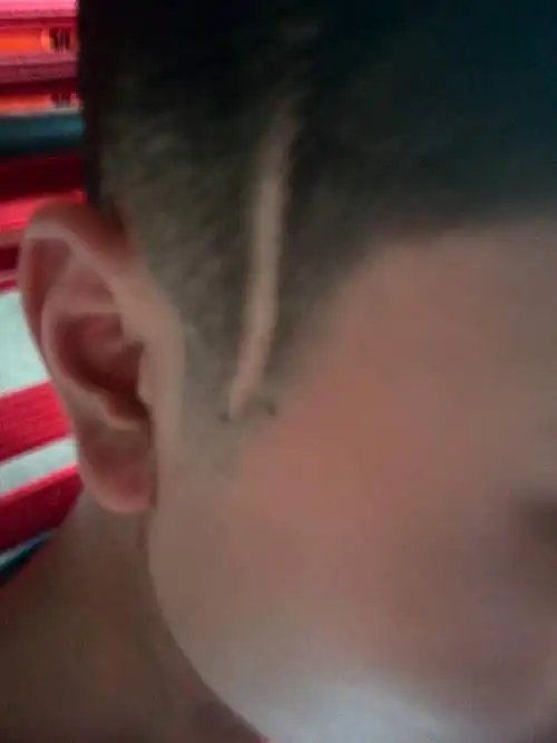 小时候头部动手术留下的刀疤,到现在都长不了头发,求解怎么办