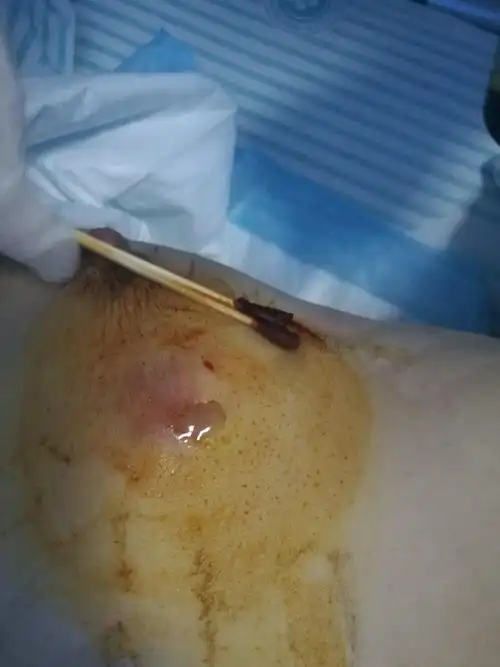 肉芽肿性乳腺炎如何治疗