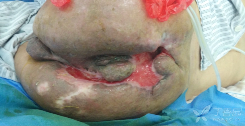 求助:会阴部大面积皮肤软组织坏死该如何处理. [病例帖]