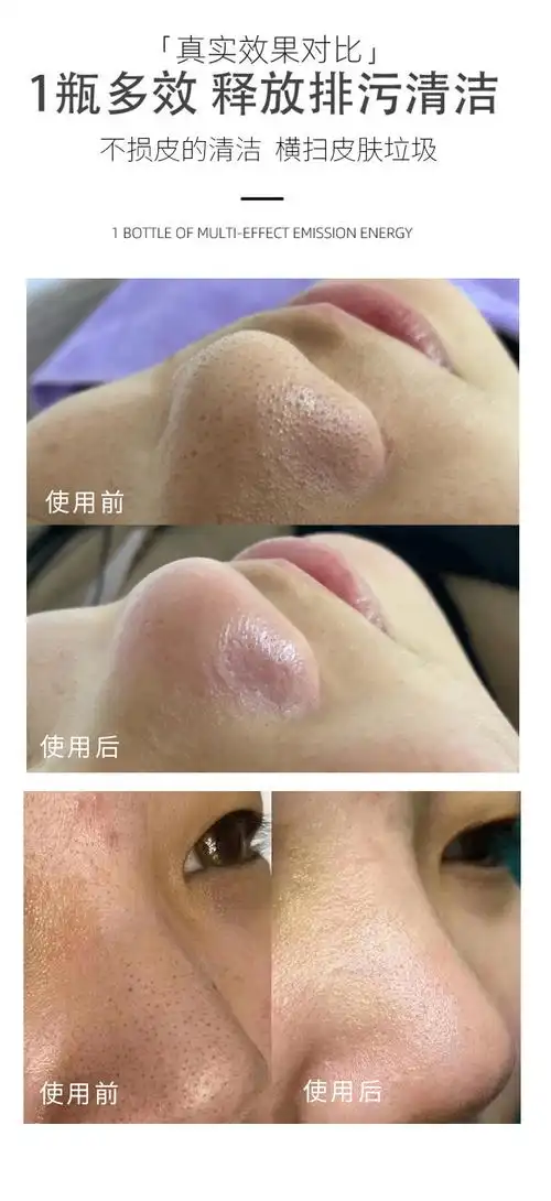 美容院黑头毛囊清洁术毛孔洗澡净化霜深层去角质黑头排污按摩膏