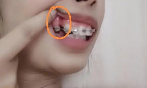 拔过牙的地方牙龈凹陷了,有人经历过这样的吗