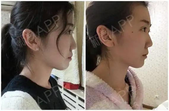 530天牙套的侧面对比