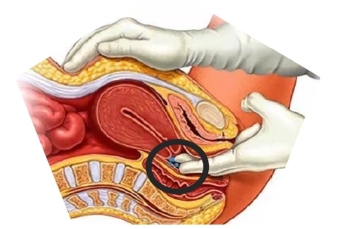 阴道上端包围着子宫颈,周围的腔隙称阴道穹窿,分前,后,左,右.